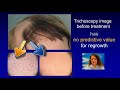Trichoscopy - prognosis for regrowth in alopecia areata
