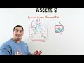 Ascites | Clinical Medicine