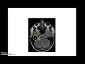 Acoustic Neuroma (Vestibular Schwannoma) - ENT