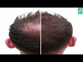 How To Stop Hair Fall & Hair Thinning And Regrow Hair Fast | Hair Thickness Vitamins.
