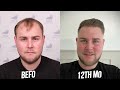 LEWIS' AMAZING RESULTS with SMILE! | Before&After | Sime Hair Clinic