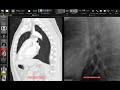 Basic chest x-ray anatomy