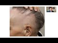 Scarring Alopecia  - Question and Answer Session