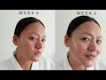 I cleared my rosacea in just 6 weeks with skincare ⎜Raw vlog with evidence based results