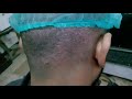 SECOND DAY OF FUE HAIR TRANSPLANT