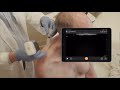 Suprascapular Nerve Block  - Ultrasound Scanning Technique