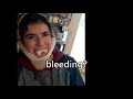 wisdom teeth removal aftermath video that my sister took