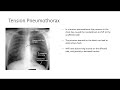 EMT Lecture: Chest Injuries