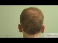 Worst Hair Transplant Result - Repair Using FUE & BHT, with Beard & Body Hair - Dr Umar part 2 of 3