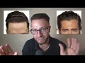 6 Warning Signs Hair Transplant is Not For You!