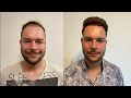 Hair Transplant Before and After - Month by Month Results | Elithair #5