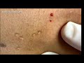 Acne clear - Blackhead removal - Beauty care video #47