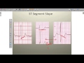 Effects of Ischemia on the ECG