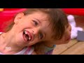 Conjoined twins share taste, sight, feelings and thoughts | 60 Minutes Australia