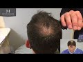 Hair Transplant Results  -  3464 FUT Grafts - 6 months only- The Maitland Clinic