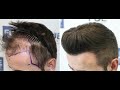 FUE Hair Transplant (4275 Grafts NW III-IV - DPA) By Dr Juan Couto - FUEXPERT CLINIC - Madrid, Spain