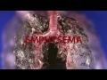 Emphysema vs Bronchitis