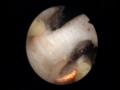 bipolar TURP using the Olympus TURIS system