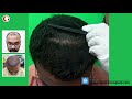 Best Hair Transplant Result In India |  Grade 6 Baldness - 6000 Grafts |