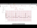 ECG Waves Segments Intervals