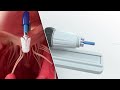 PASCAL Precision System – Implantation of the device in the mitral and tricuspid valves | Animation