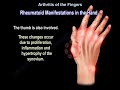 Arthritis Of The Fingers - Everything You Need To Know - Dr. Nabil Ebraheim