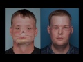 Mayo Clinic’s First Face Transplant: The Surgery