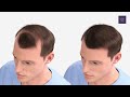 What is an FUE hair transplant?