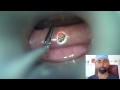 Trans-Oral Laser for the Treatment of Zenker’s Diverticulum | Dr. Babak Larian in Los Angeles