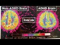 Brain Image Differences of Non ADHD vs ADHD