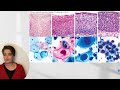 Medical School Pathology: Pathophysiology of Carcinoma of the Cervix