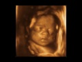 28 Weeks Baby 3D 4D Ultrasound - My Sunshine Baby Charlotte
