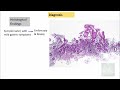 AUTOIMMUNE ATROPHIC GASTRITIS: Pathogenesis, clinical features, morphology & prognosis