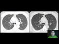 Lung Cancer Screening 2022 Update (basics for patients)