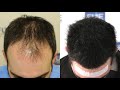 FUE Hair Transplant (3467 + 1000 grafts in NW - Class IV - A), Dr. Juan Couto - FUEXPERT CLINIC