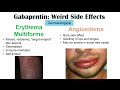 Gabapentin Weird Side Effects (Skin, Psychological, Eyes)