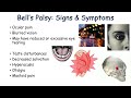 Bell’s Palsy (Facial Paralysis) | Causes, Pathophysiology, Signs & Symptoms, Diagnosis, Treatment