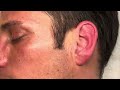 [ASMR] Auricular (Ear) Acupuncture Treatment | Real Person ASMR 💜 ft. Tom