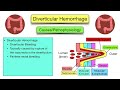 🔥 Diverticular Disease: Diverticulitis vs Diverticulosis [Symptoms, Treatment, Diet]