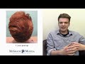Hair Transplant Results - Case Study of Young Male Hair Loss Patient