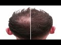 White Hair To Black Hair Naturally & Permanently | 100% Guaranteed Result For Premature Grey Hair.