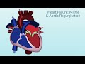 Rheumatic Heart Disease by E. Rusingiza | OPENPediatrics