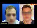 FUE Hair Transplant Result - 3079 Grafts (26 Year Old | Before & After Results | BHR Clinic)
