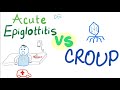 Acute Epiglottitis Vs Croup | A Detailed Comparison