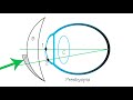 How Opticians Use Lenses To Correct Refractive Errors