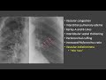 Pulmonary Edema