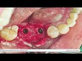 Buccal GBR with Wide cover cap - [Dr. Kim Jaeyoon]