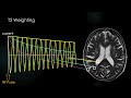 The Turbo & Fast Spin Echo Sequence - MRI Pulse Sequences EXPLAINED | MRI Physics Course Lecture 10