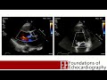 Level 1 Video Lecture: Valvulopathies