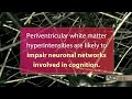 Cerebral small vessel disease progression linked to MCI in hypertensive patients